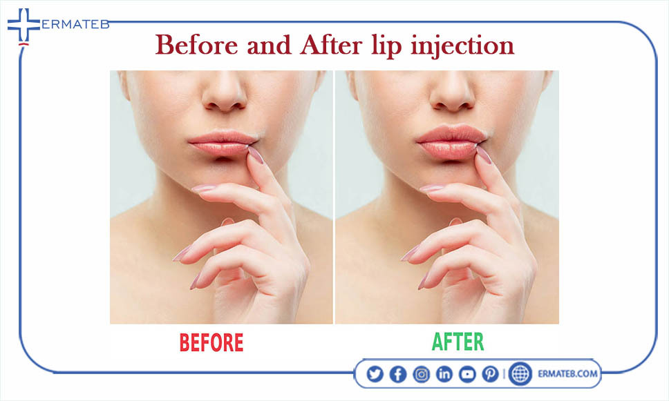 before and after lip injection